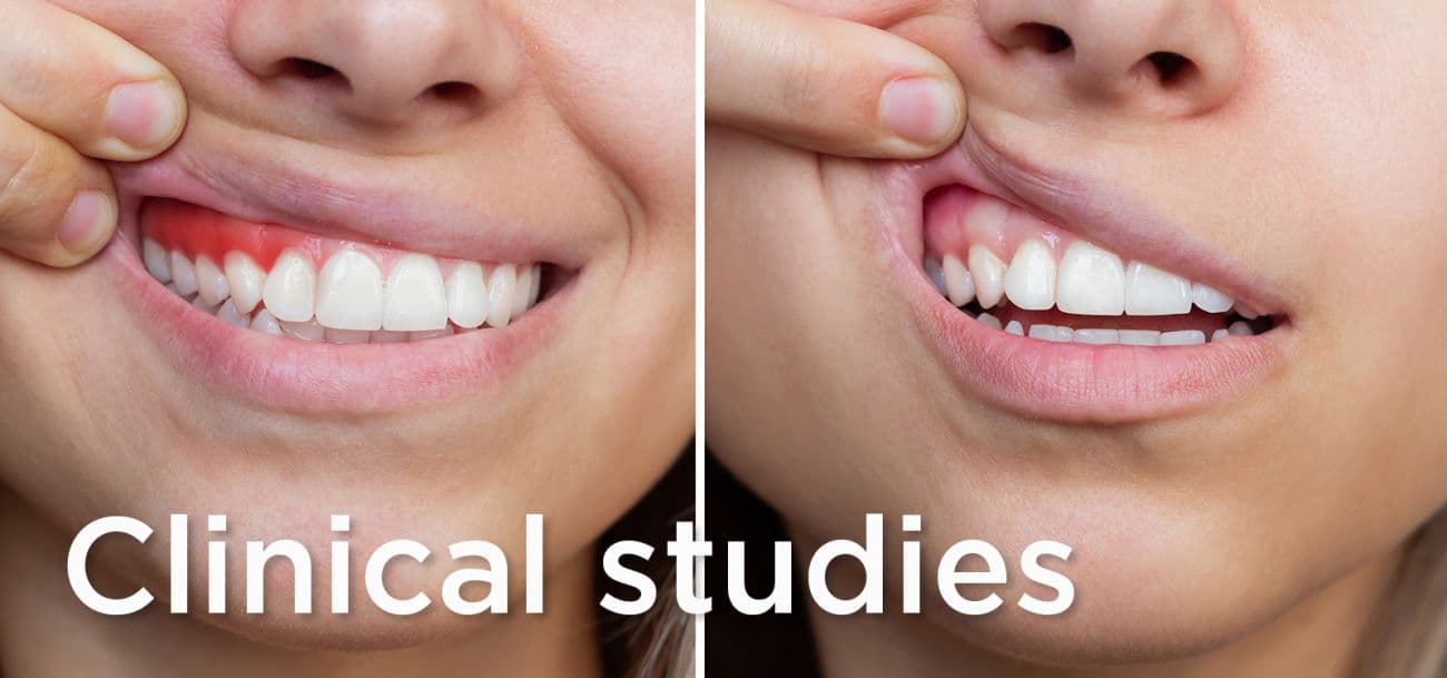 Treatment of peri-implant mucositis using spermidine and calcium chloride as local adjunctive delivery to non-surgical mechanical debridement: a double-blind randomized controlled clinical trial